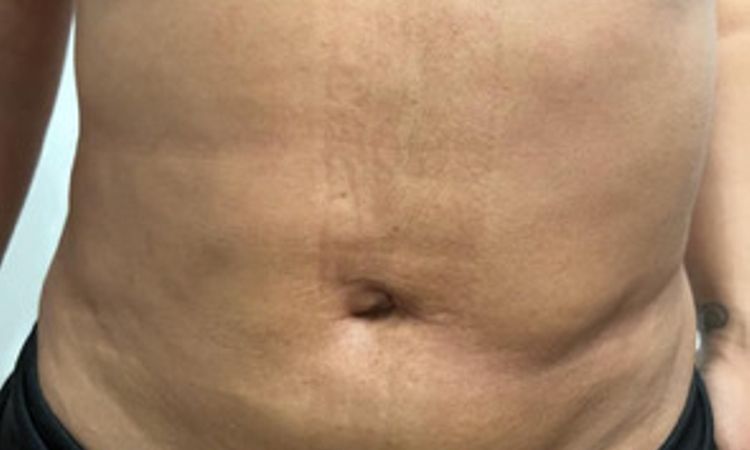 Unzufrieden nach Fettabsaugung| Liposuction trotzt J-plasma am Bauch - 77187