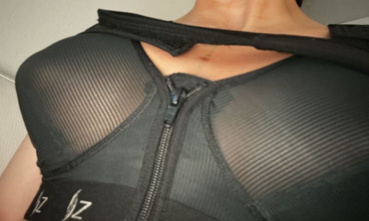 Extrem spitze Brust nach Brustvergrößerung - 77198
