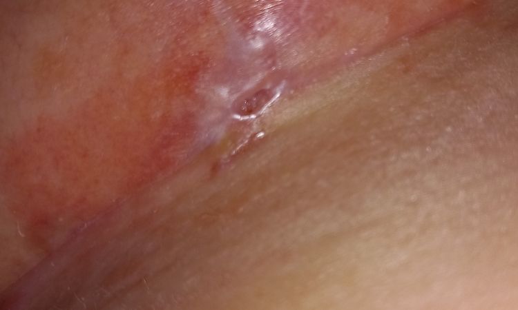 Brustverkleinerung kleines Loch - 77292