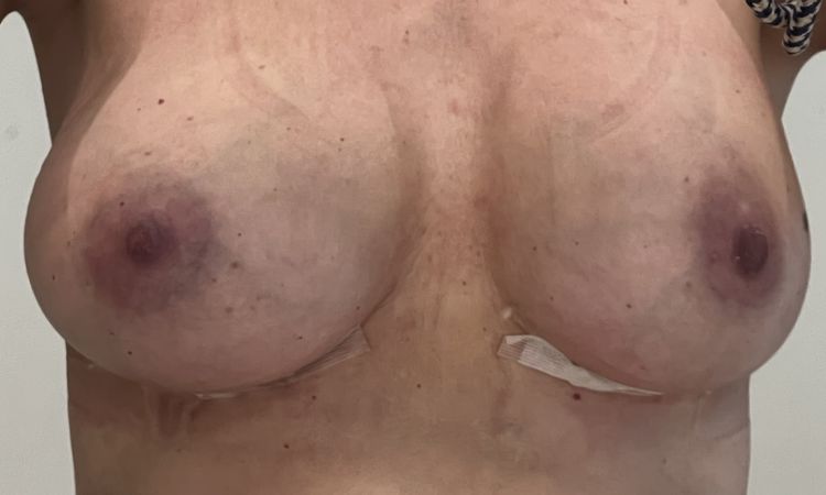 Repositionierung einseitig nach Brustvergrösserung - 77398