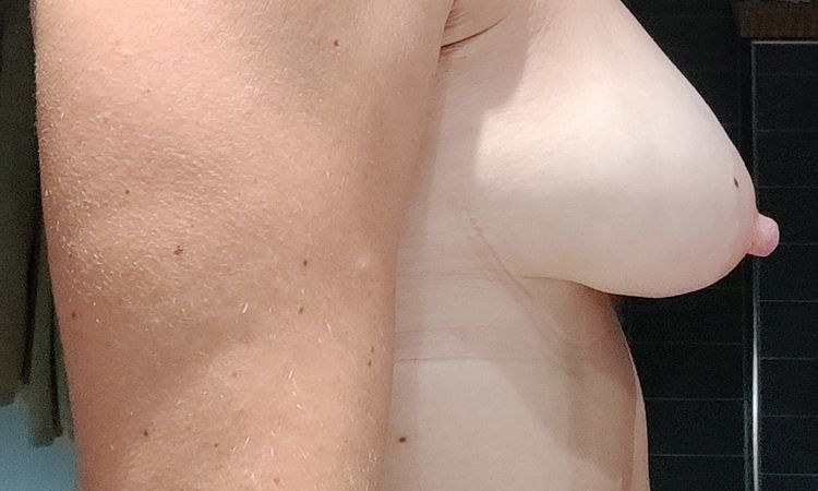 Waterfall Deformity Vorgehensweise nach Explantation - 77431