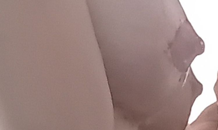 Ist es eine Waterfall Deformity? - 77567