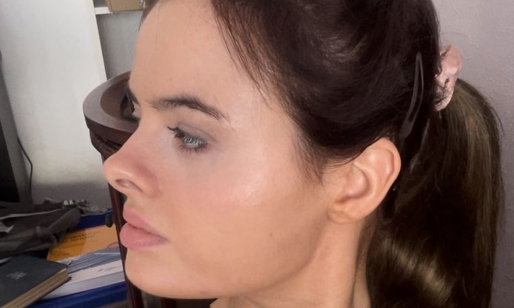 Fillers für einen jüngeren und freundlichen Look? - 77575