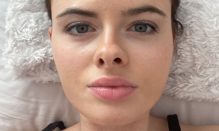 Fillers für einen jüngeren und freundlichen Look? - 77579