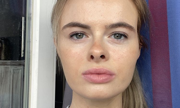 Fillers für einen jüngeren und freundlichen Look? - 77581