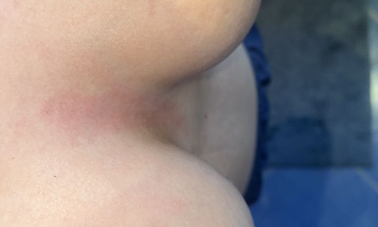 Mein Brustwarzenhof steht nach der Brust OP ab und ist weit unten bleibt das so? - 77647