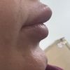 Ist der Lipfiller migriert?