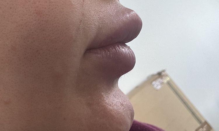 Ist der Lipfiller migriert? - 77712