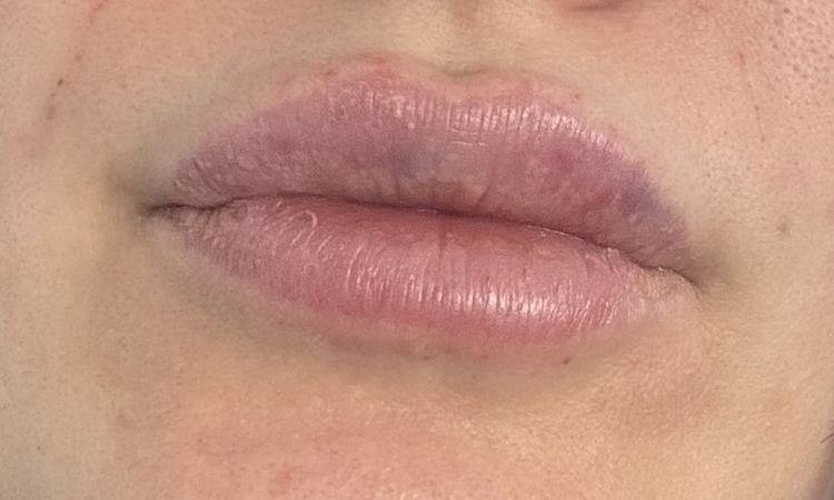 Ist der Lipfiller migriert? - 77713