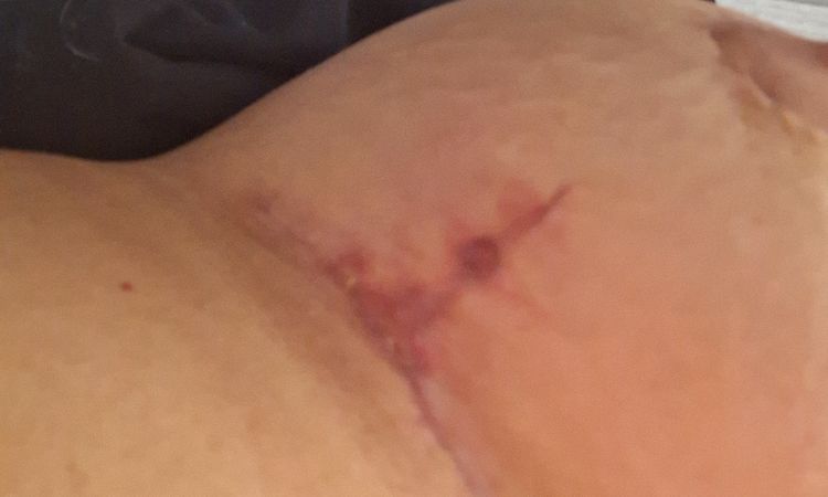 Löcher in der Narbe nach Brustvergrößerung und -straffung bei tubulärer Brust - 77803