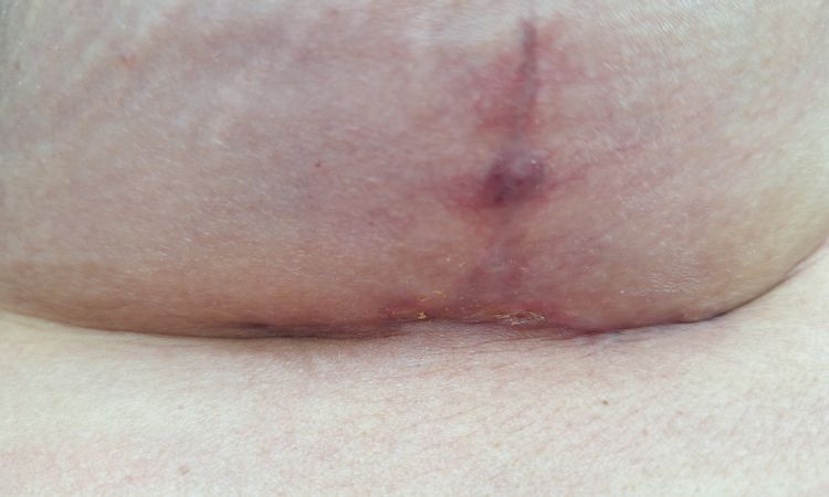 Löcher in der Narbe nach Brustvergrößerung und -straffung bei tubulärer Brust - 77804