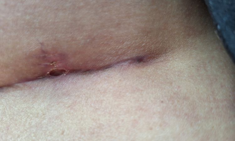 Löcher in der Narbe nach Brustvergrößerung und -straffung bei tubulärer Brust - 77806