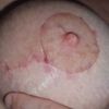 5 Wochen nach BV und Straffung kleines" Loch" das nicht zu geht an der Areola