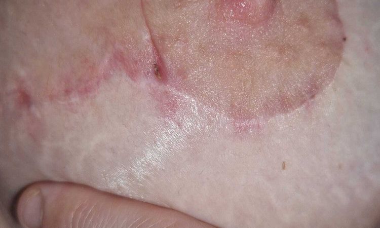 5 Wochen nach BV und Straffung kleines" Loch" das nicht zu geht an der Areola - 78006