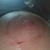 5 Wochen nach BV und Straffung kleines" Loch" das nicht zu geht an der Areola
