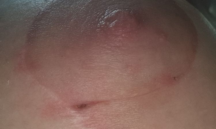 5 Wochen nach BV und Straffung kleines" Loch" das nicht zu geht an der Areola - 78007