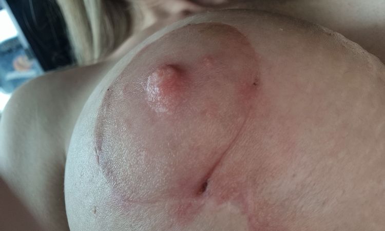 5 Wochen nach BV und Straffung kleines" Loch" das nicht zu geht an der Areola - 78008