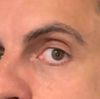 Ist das Ptosis oder was anderes?