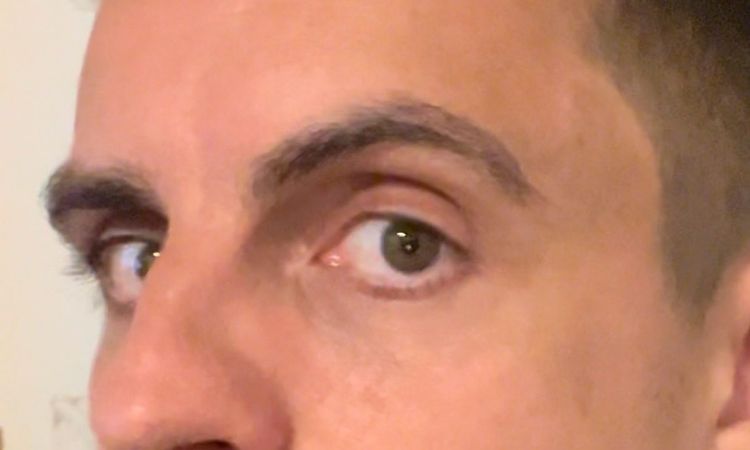 Ist das Ptosis oder was anderes? - 78140