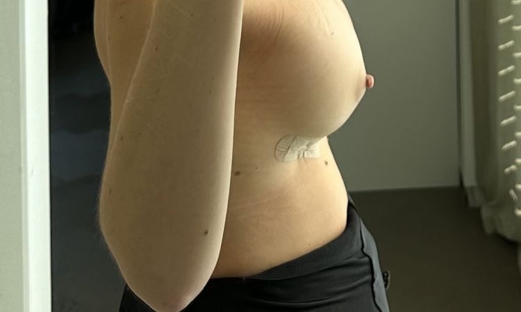 Snoopy deformity ? Bleibt mein Busen so? - 78228