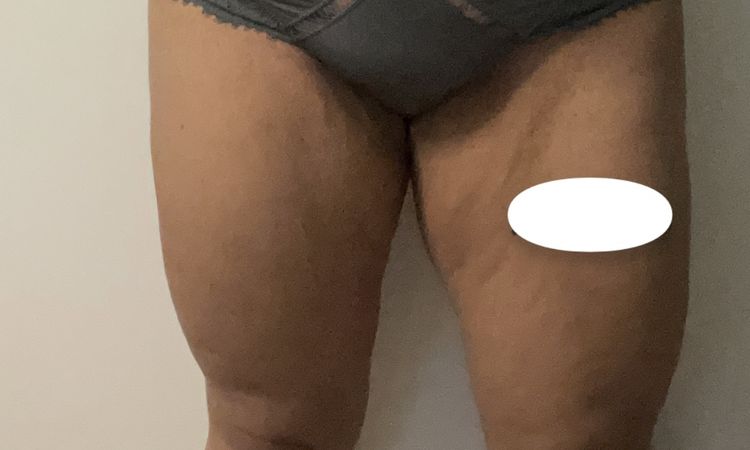 Fettabsaugung mit J Plasma oder lieber Straffung? - 78284