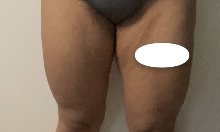 Fettabsaugung mit J Plasma oder lieber Straffung? - 78285