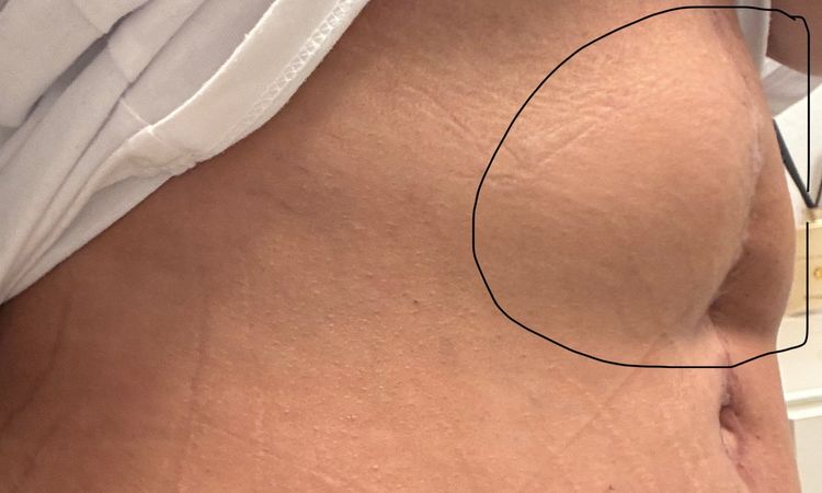 Bauchdeckenstraffung korrigieren? - 78388