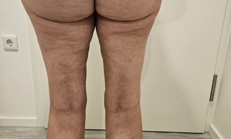 Übersaugung Innenschenkel,  Liposuktion Februar 2024 - 78473