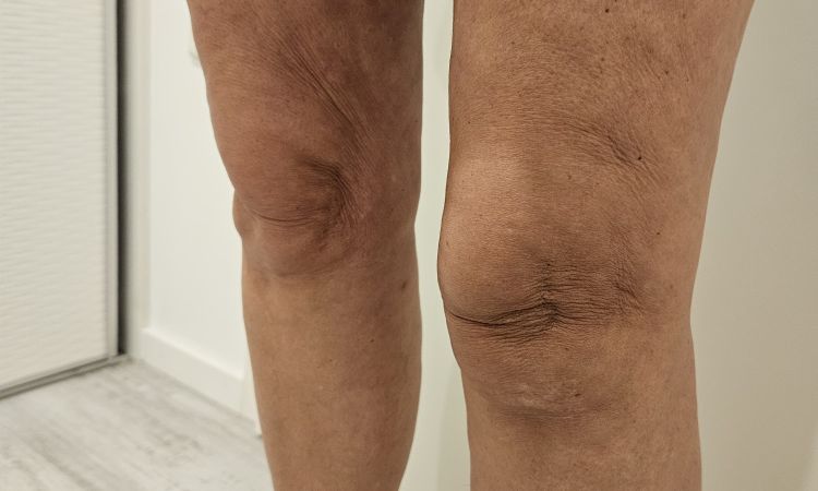 Übersaugung Innenschenkel,  Liposuktion Februar 2024 - 78474