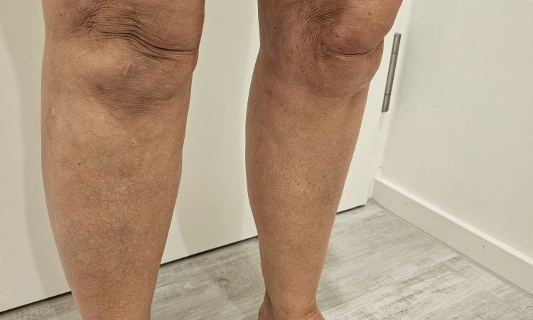 Übersaugung Innenschenkel,  Liposuktion Februar 2024 - 78475