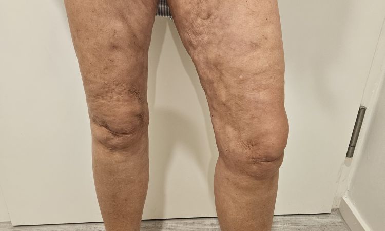 Übersaugung Innenschenkel,  Liposuktion Februar 2024 - 78476