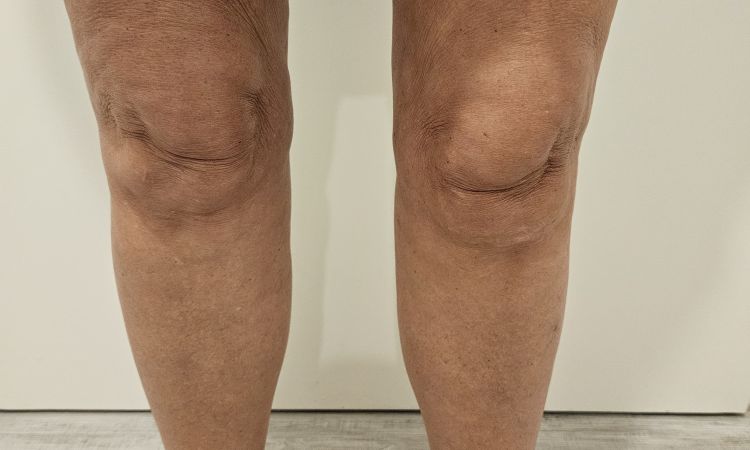 Übersaugung Innenschenkel,  Liposuktion Februar 2024 - 78477