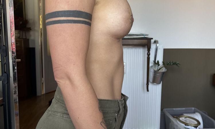 Brustimplantat zu hoch gesetzt? - 78623