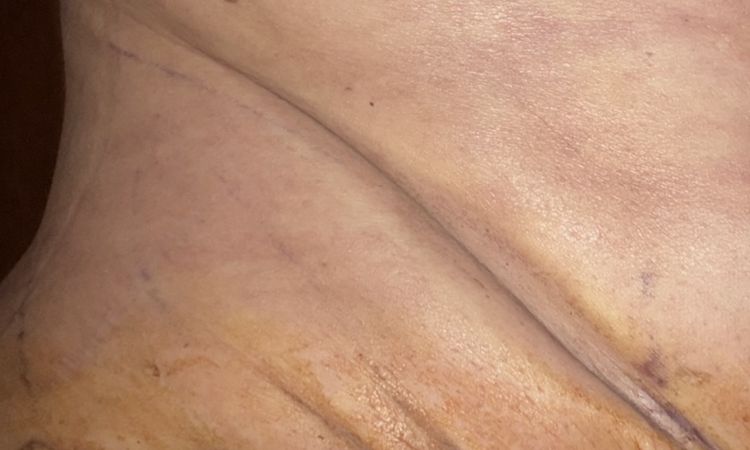 Bauchdeckenstraffung Komplikationen - 78748