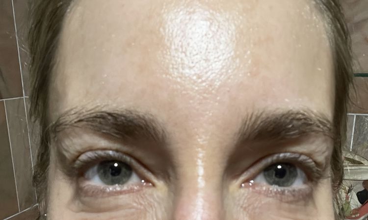 Botox Krähenfüße Mehr Falten unter den Augen - 78756