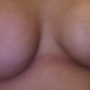 Nicht gelungene Brust op/Schadensersatz?