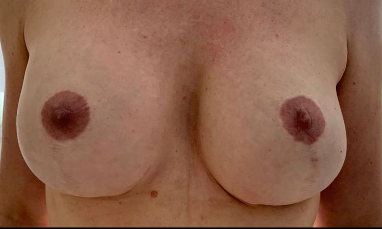 Linke Brust zu tief nach Implantataustausch? - 78835
