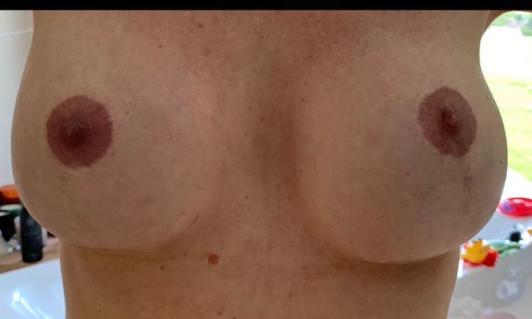 Linke Brust zu tief nach Implantataustausch? - 78836