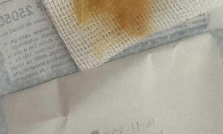 Verhärtung nach Brustverkleinerung - 78852