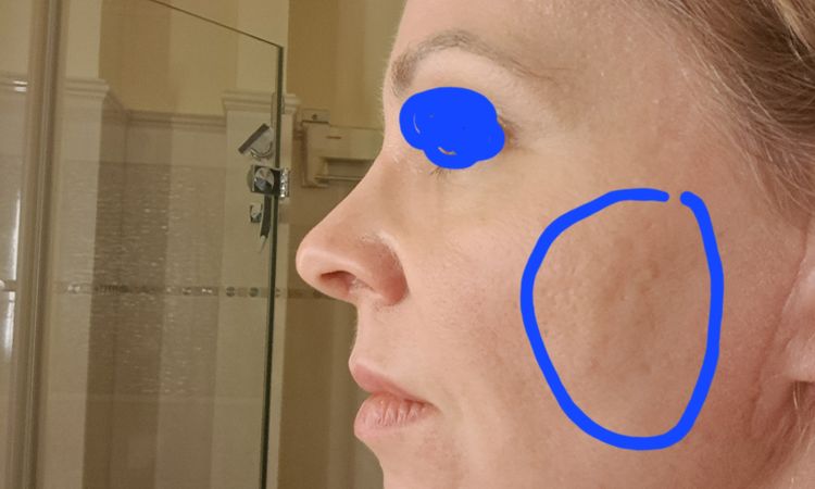 Fibrose nach Facelift - 78873