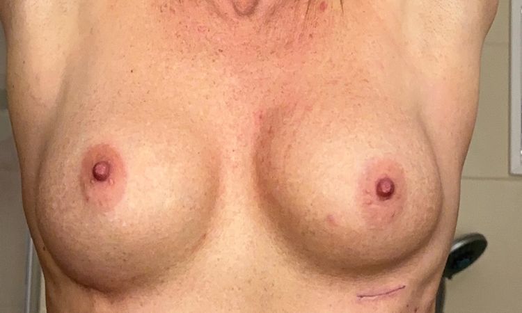 6 Wochen Post-OP Brustvergrößerung - 78953