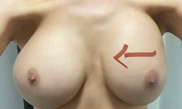 Implantate unterschiedlich hoch? - 79065