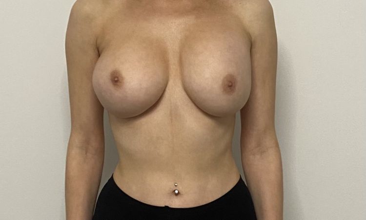 Implantate unterschiedlich hoch? - 79066