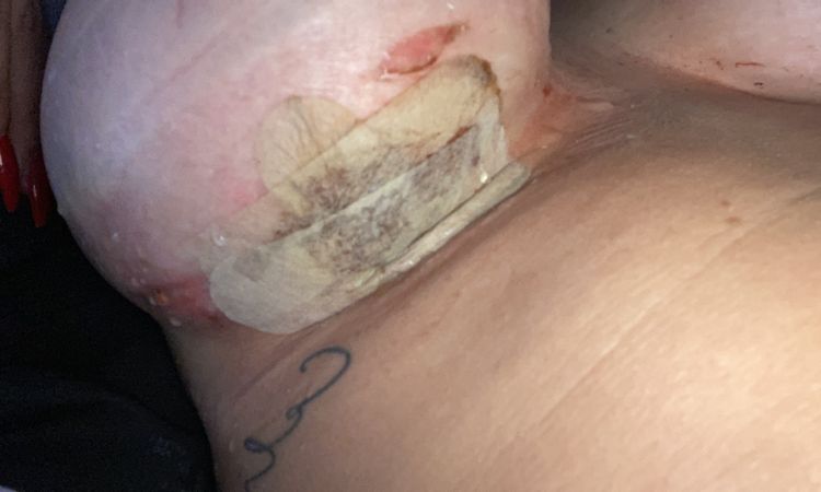 Implantat Entzündung - 79247