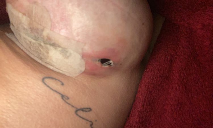 Implantat Entzündung - 79248