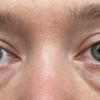 Unterlidkorrektur: Blepharoplastik mit/ohne Laser oder Eigenfett