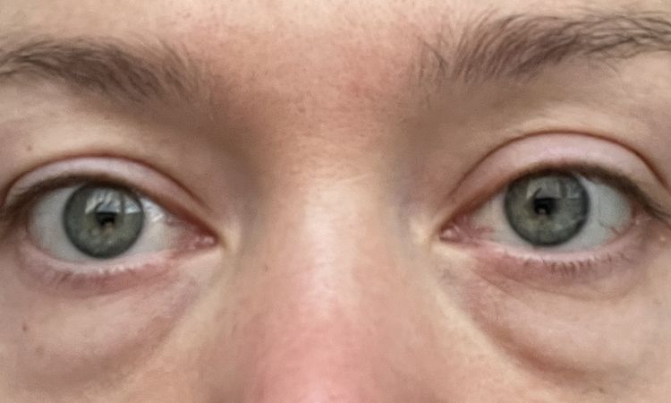 Unterlidkorrektur: Blepharoplastik mit/ohne Laser oder Eigenfett - 79261