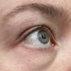 Unterlidkorrektur: Blepharoplastik mit/ohne Laser oder Eigenfett