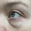 Unterlidkorrektur: Blepharoplastik mit/ohne Laser oder Eigenfett