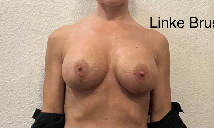 Asymmetrie nach Bruststraffung T-Schnitt mit Implantatwechsel 4 Wochen post-OP - 79320